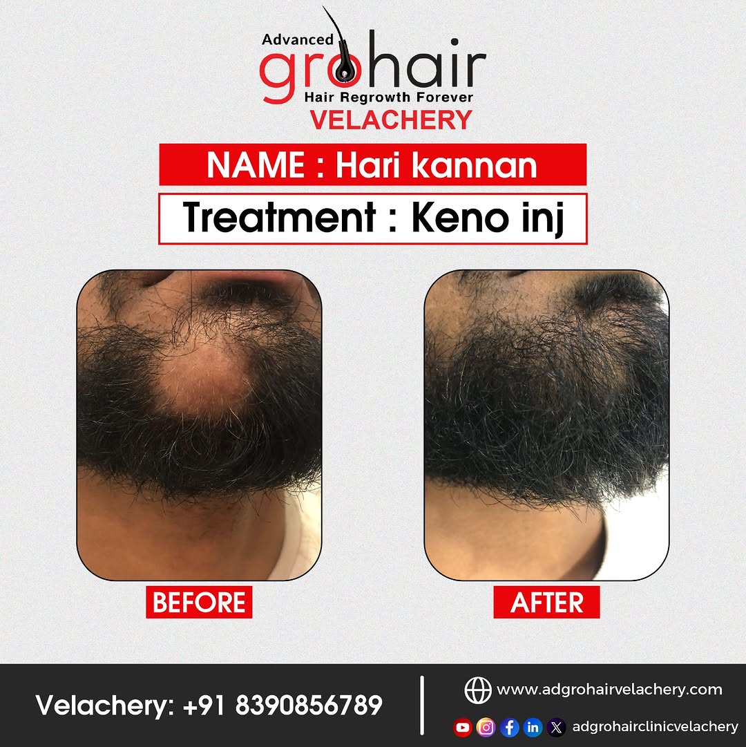 Hair Transplant Results - Before and After - Case 3