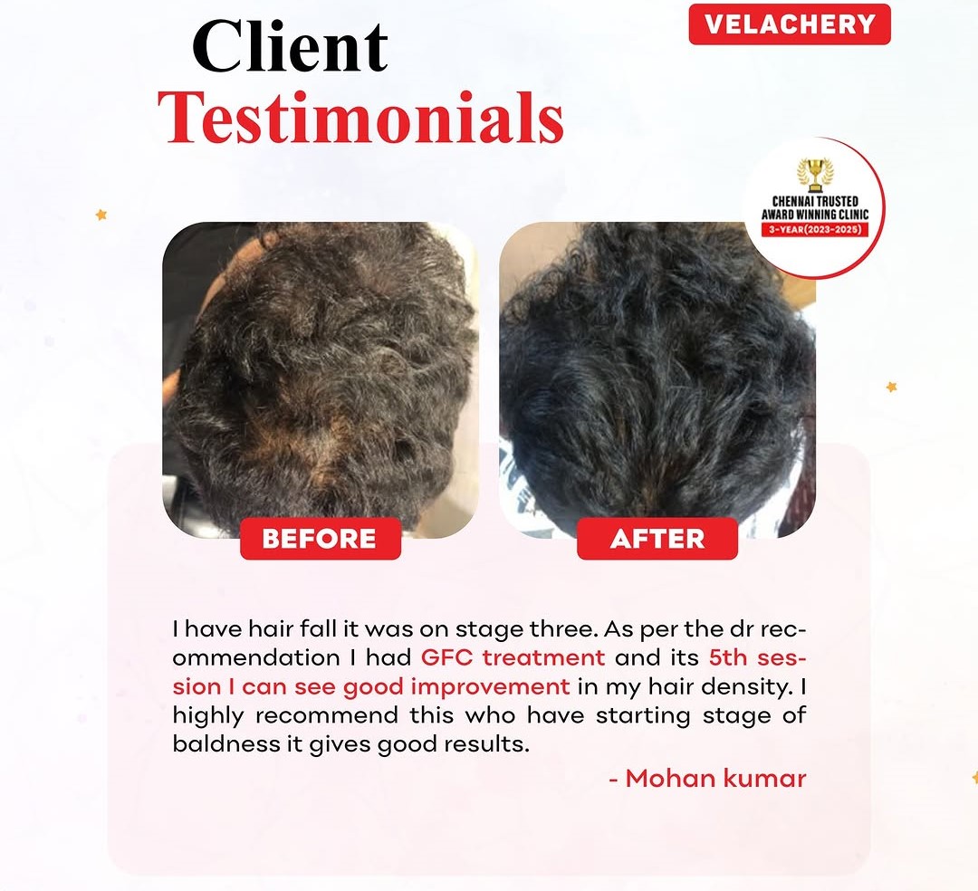 Hair Transplant Results - Before and After - Case 3