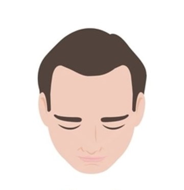 Stage 1
